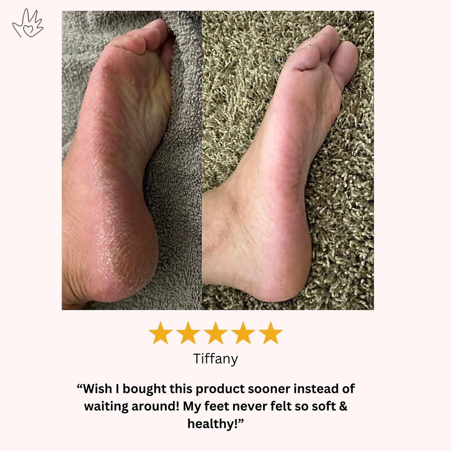 Electric Foot Callus Remover™️